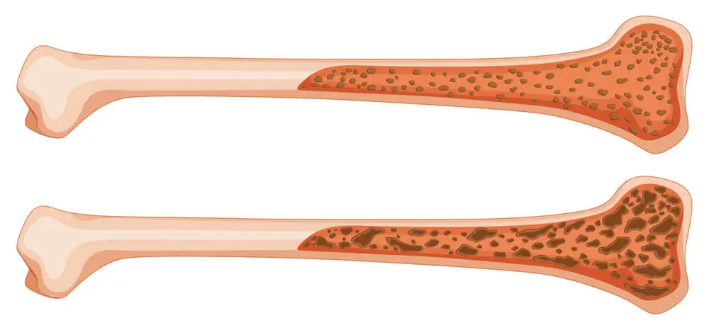 Bone Marrow Transplant 